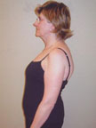 May 2006 Scoliosis Progression
